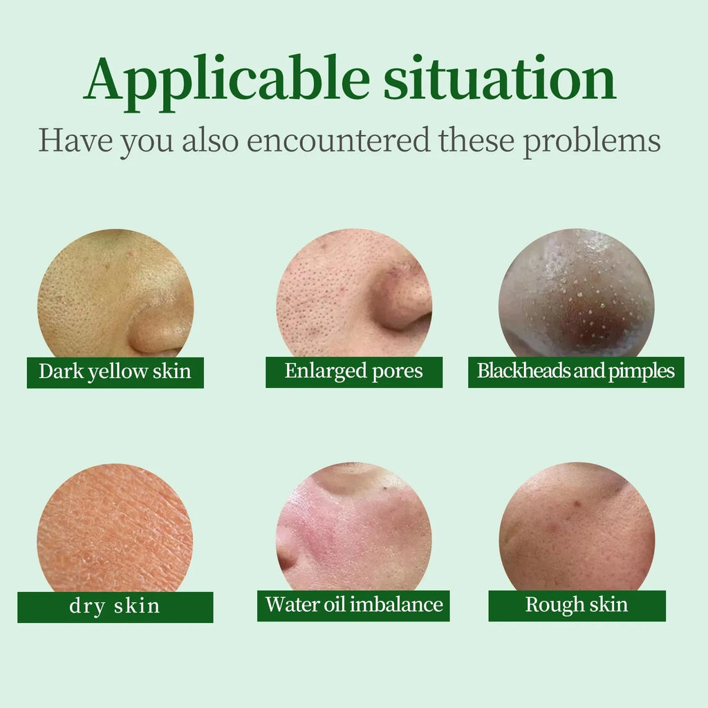 Seaweed Algae Peel Kit for Acne Treatment - Skin Repair Facial Rejuvenation Whiten & Brighten Cleanse Functional Skincare ﻿